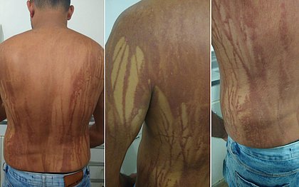 Turista com manchas na pele após banho de mar em Ilhéus piora e é internado